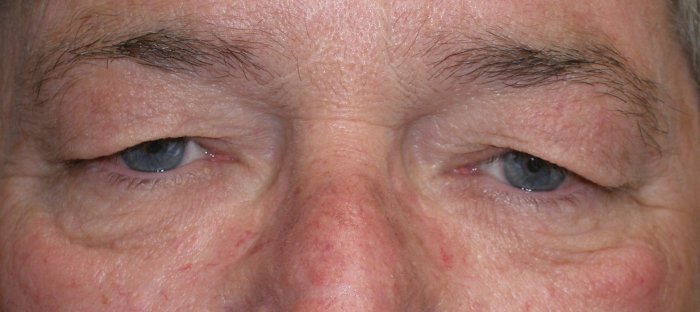 this patient shows advanced aging changes of the eyelids