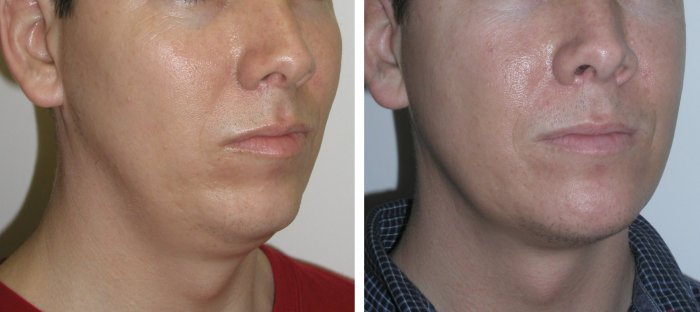 Facial Implants for men in Richmond