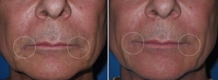 Before and after Botox and injectable fillers, photos of male patient