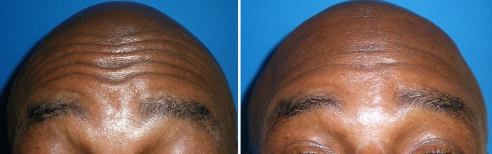 Before and after Botox and injectable fillers, photos of male patient