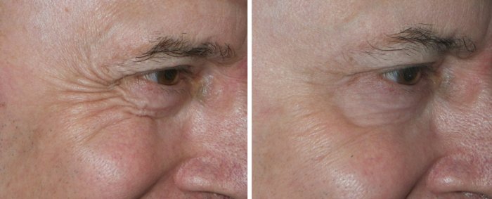 Before and after Botox and injectable fillers, photos of male patient