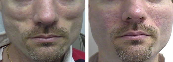 Before and after Botox and injectable fillers, photos of male patient