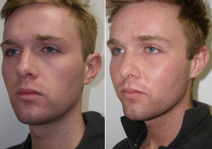 this patient shows severe upper and lower lid aging