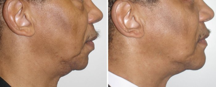Before and after chin implants