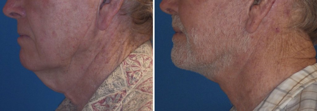 Facelifts for Men in Richmond