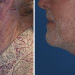 Facelifts for Men in Richmond
