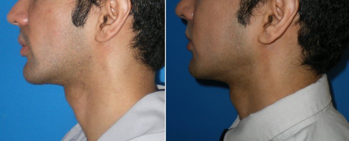 Facial Implants for men in Richmond