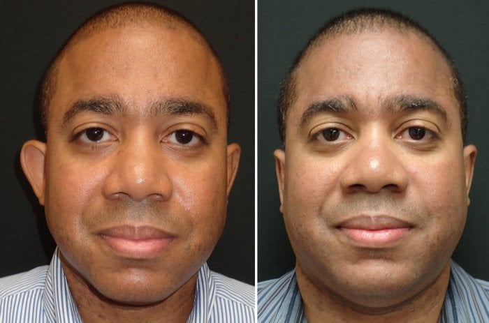 Before and after Otoplasty correcting protruding ears