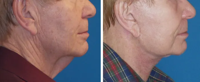 excess neck skin and jowling corrected with facelift