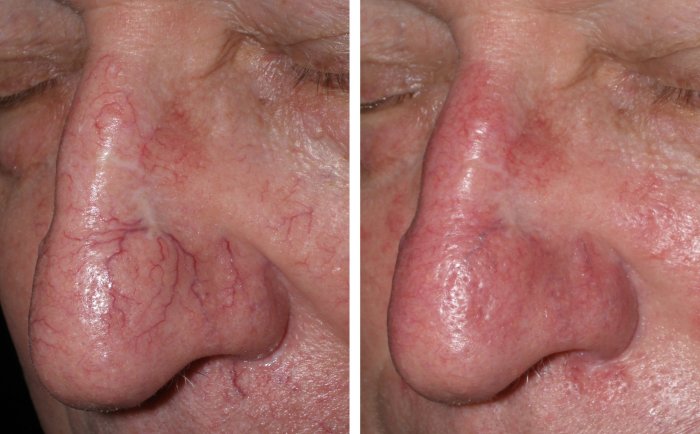Before and after spider vein removal