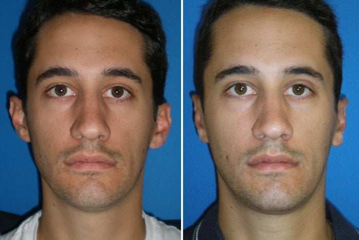 Before and after Otoplasty correcting protruding ears