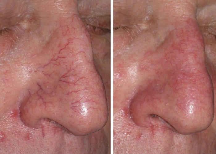 Before and after spider vein removal