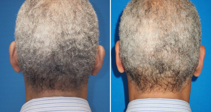 Before and after Otoplasty correcting protruding ears