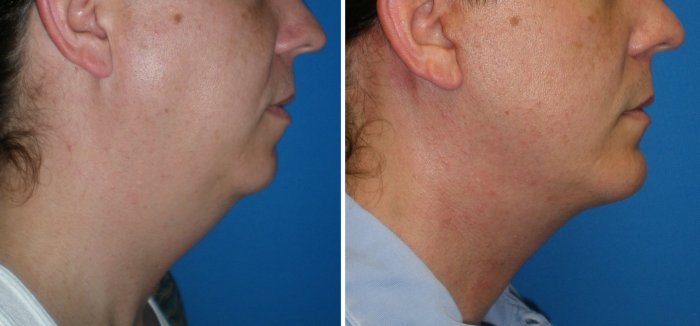 Before and after chin implants