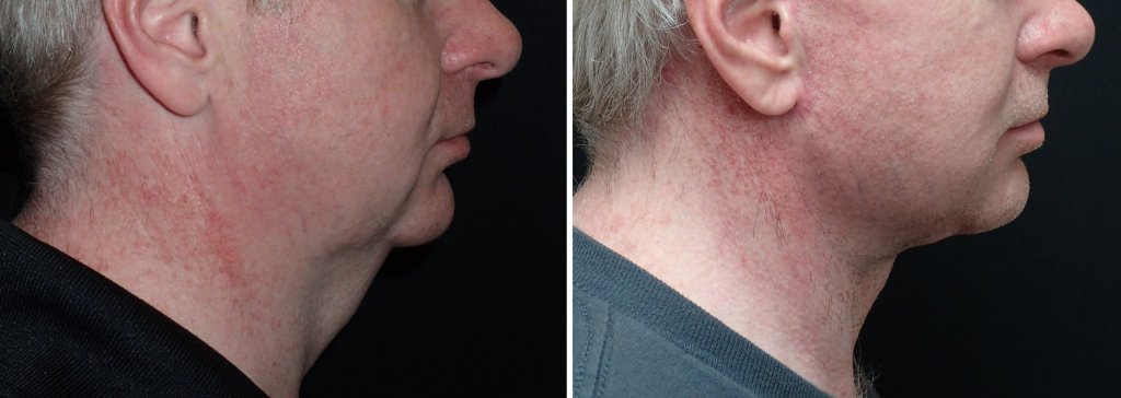 Facelifts for Men in Richmond