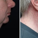 Facelifts for Men in Richmond