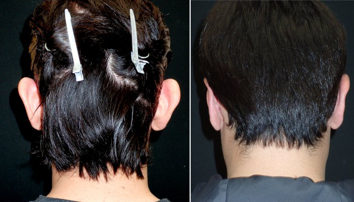Before and after Otoplasty correcting protruding ears