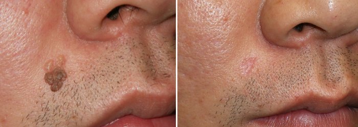 Before and after mole removal, photos of male patient