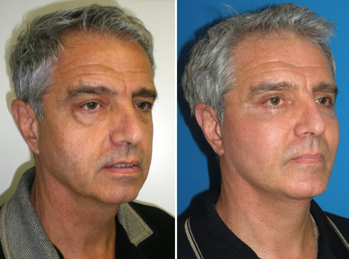 this patient shows severe upper and lower lid aging