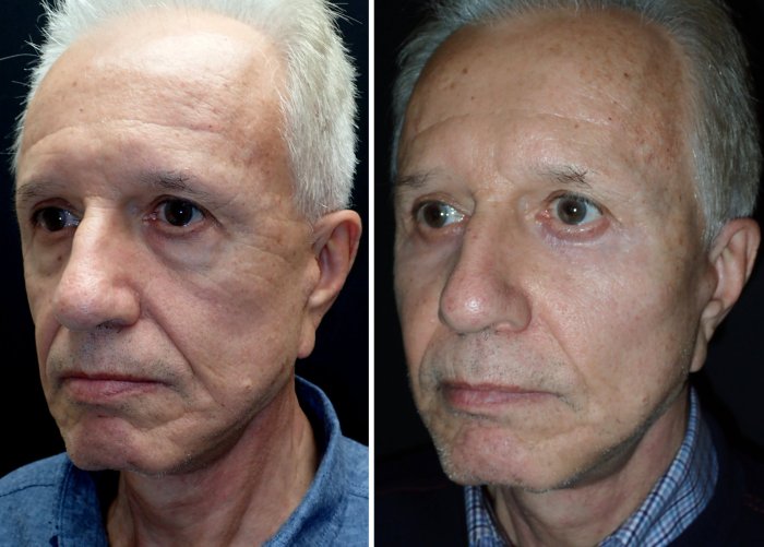 this patient shows severe upper and lower lid aging