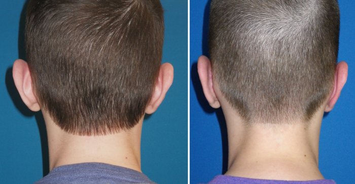 Before and after Otoplasty correcting protruding ears