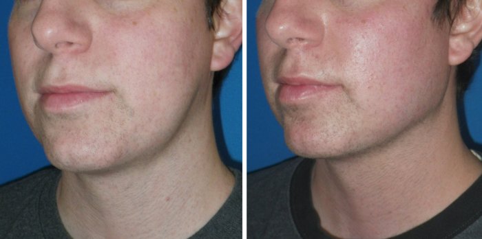 Facial Implants for men in Richmond