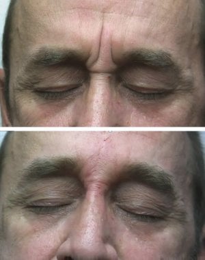 Before and after facial fillers reducing man's wrinkles