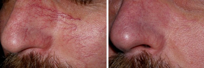 Before and after spider vein removal