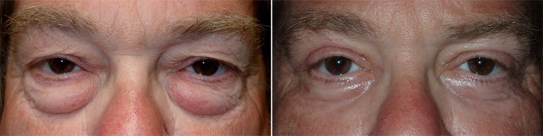 male eyelid surgery before and after