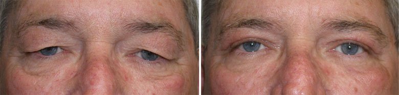 male eyelid surgery before and after