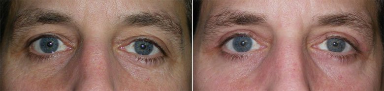 Eyelid Surgery for Men in Richmond