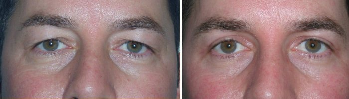Eyelid Surgery for Men in Richmond