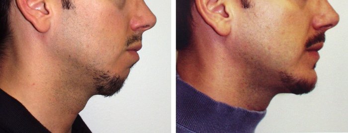 Before and after chin implants