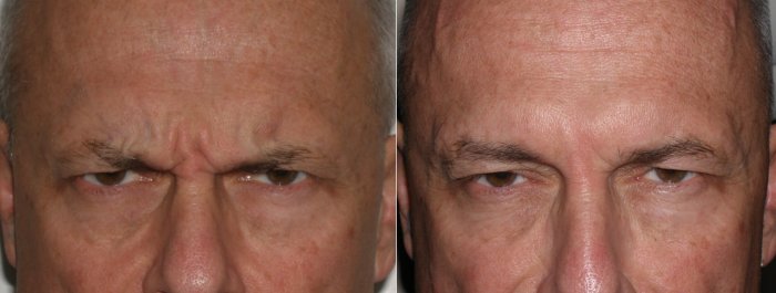 Before and after Botox and injectable fillers, photos of male patient
