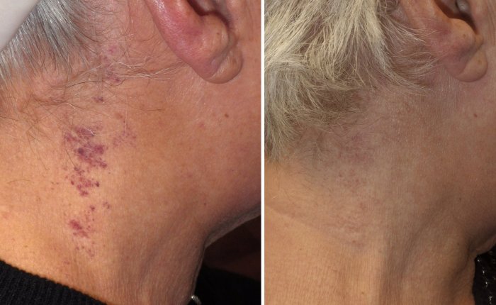 Before and after spider vein removal