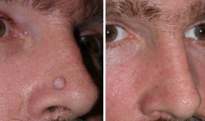 Before and after mole removal, photos of male patient