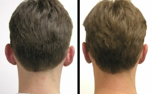 Before and after Otoplasty correcting protruding ears