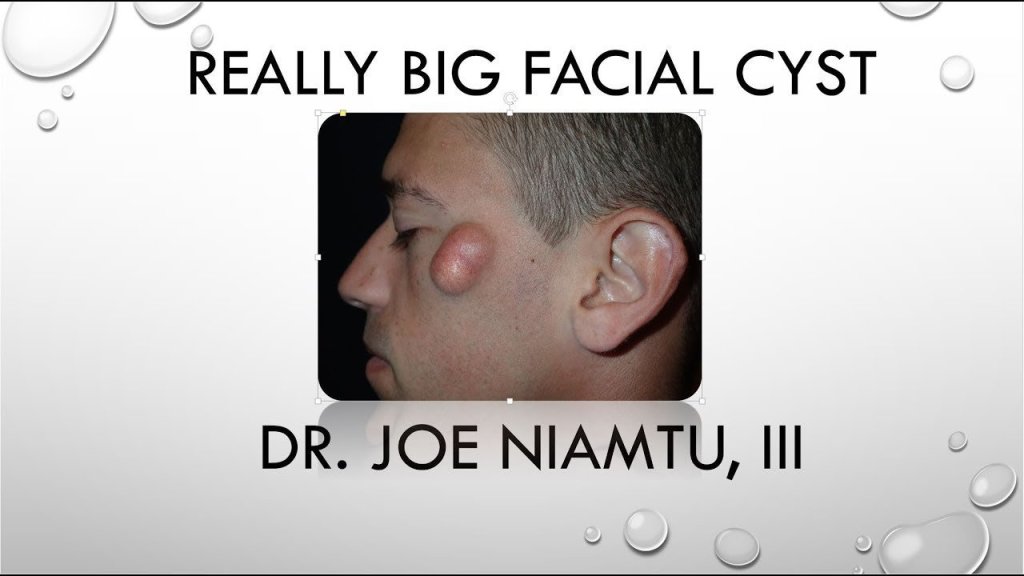 Really Big Cyst