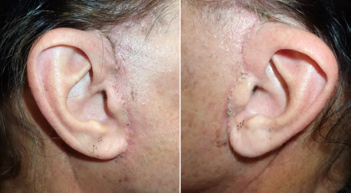 typical male facelift incision at one week