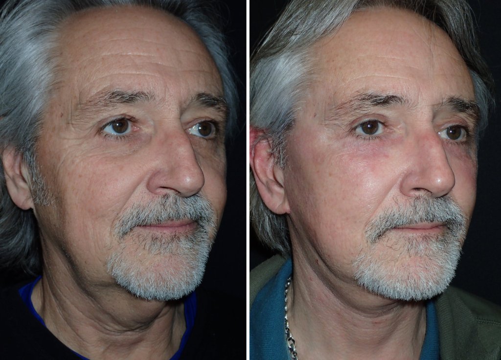 Facelifts for Men in Richmond