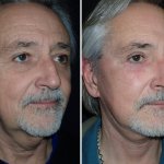 Facelifts for Men in Richmond