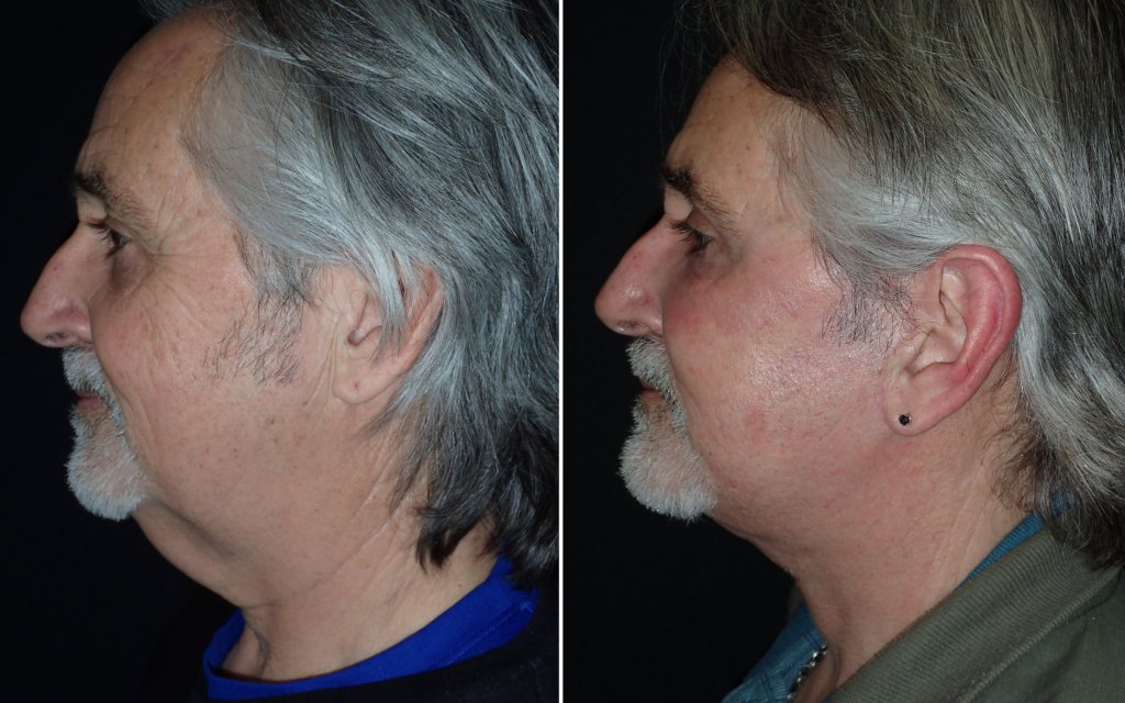 Facelifts for Men in Richmond