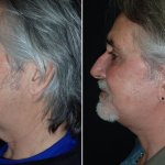 Facelifts for Men in Richmond