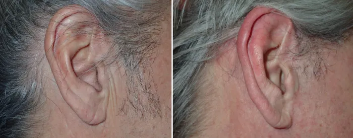 male facelift incision before surgery and 6 weeks after surgery