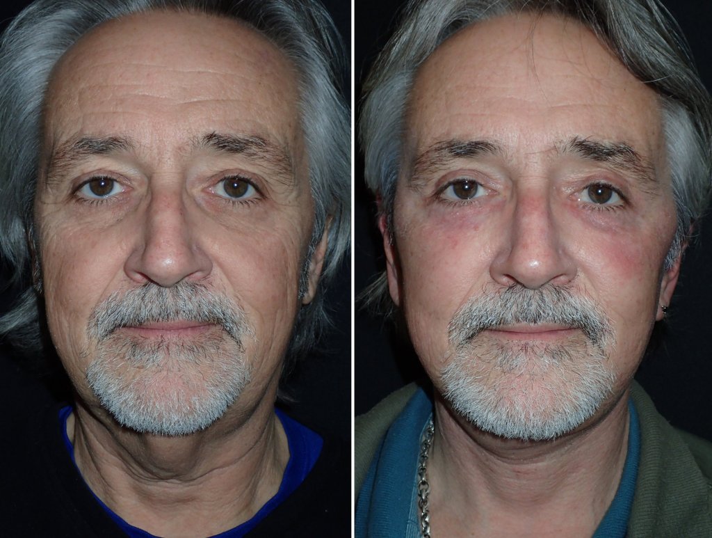 Facelifts for Men in Richmond