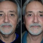 Facelifts for Men in Richmond