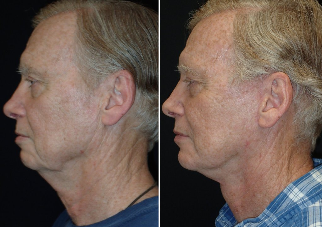 Facelifts for Men in Richmond