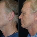 Facelifts for Men in Richmond