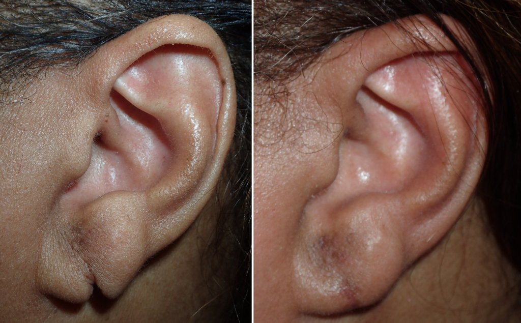 torn earlobe repair