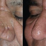 Before and After Nose Surgery